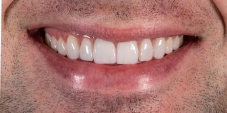 Close up of flawless smile with veneers
